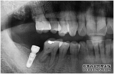 种植体成功植入后的CT效果图