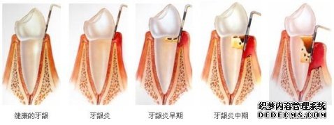 爱齿尔口腔治疗牙龈炎